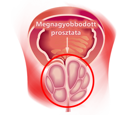 Prosztatamegnagyobbodás