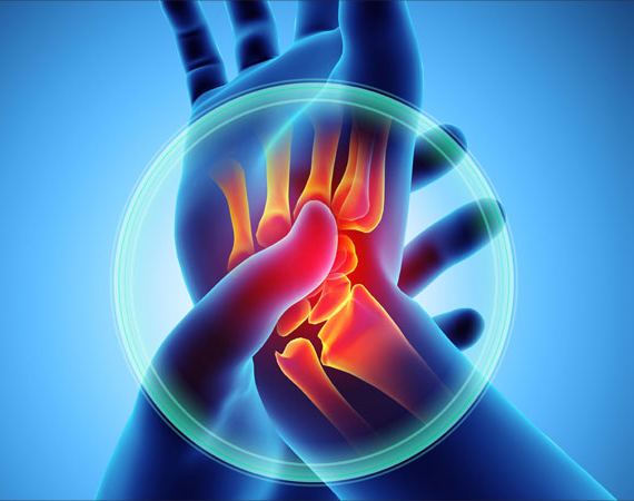 Arthritis